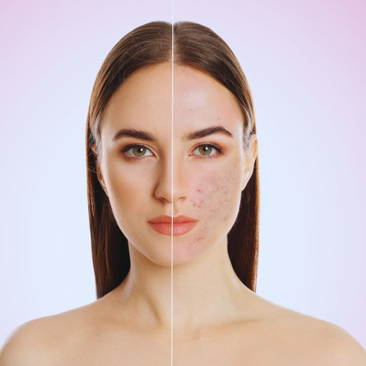 Acne & Pimples - 100% Ayurvedic – Herbalart